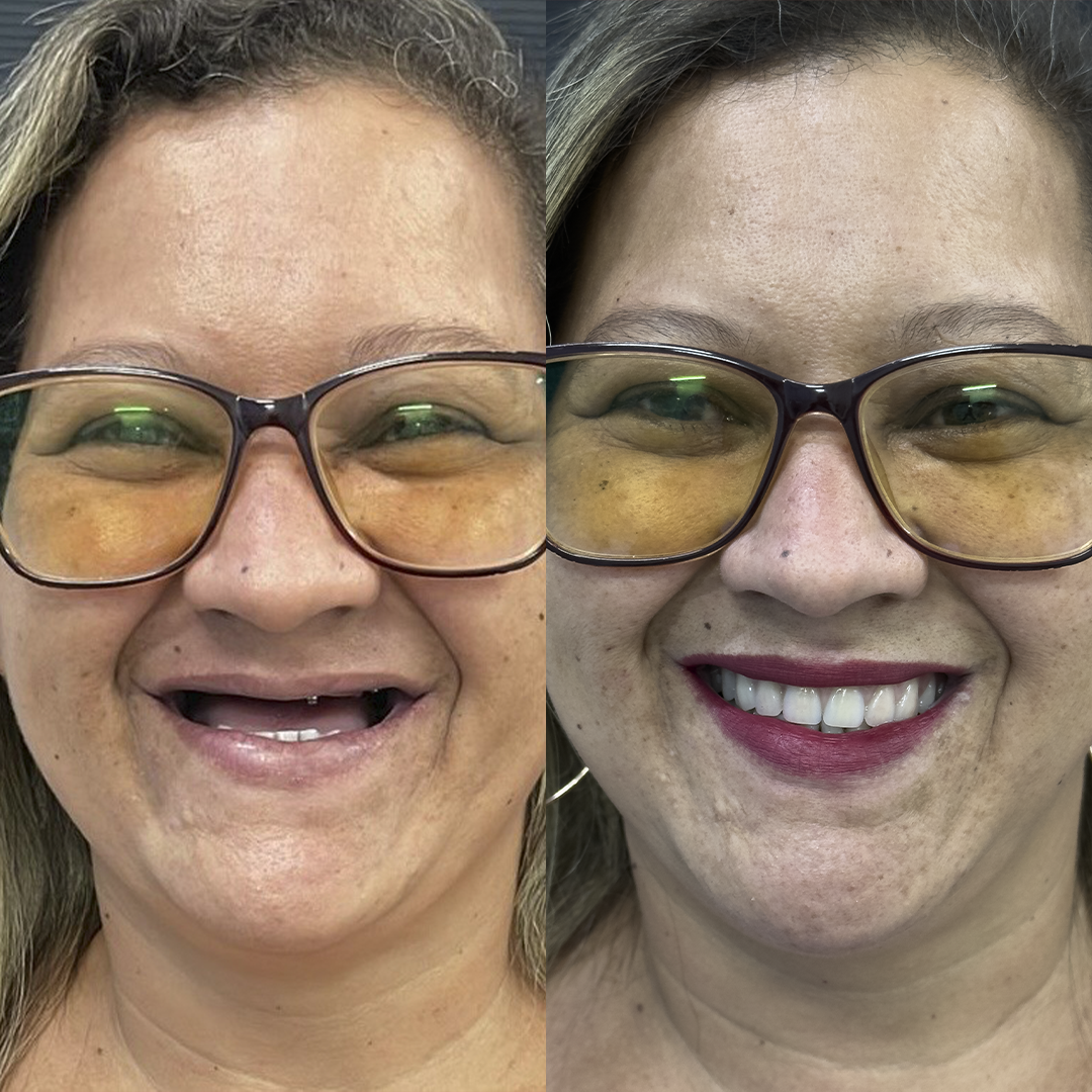 Antes e Depois-1