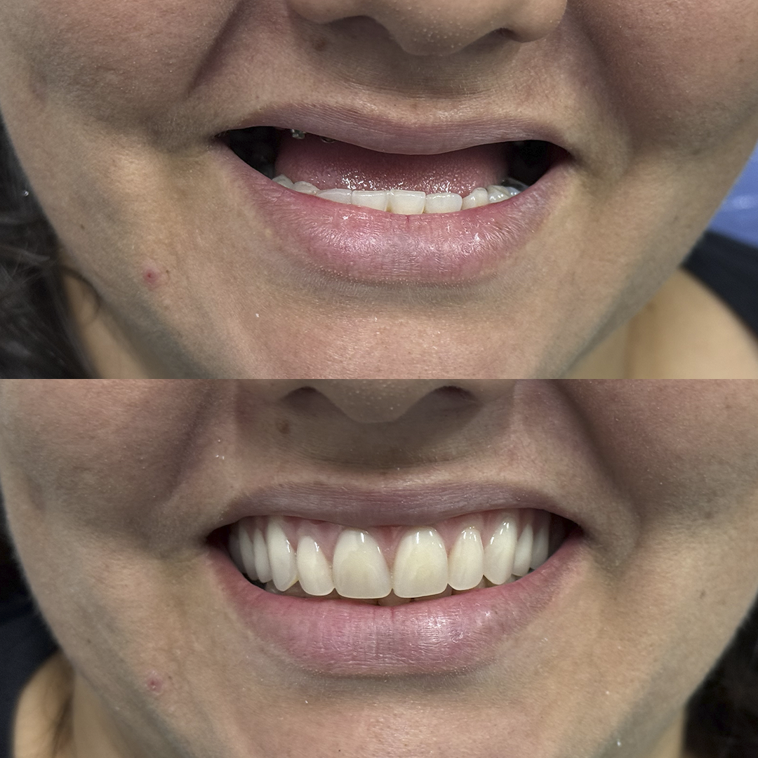 Antes e Depois-2
