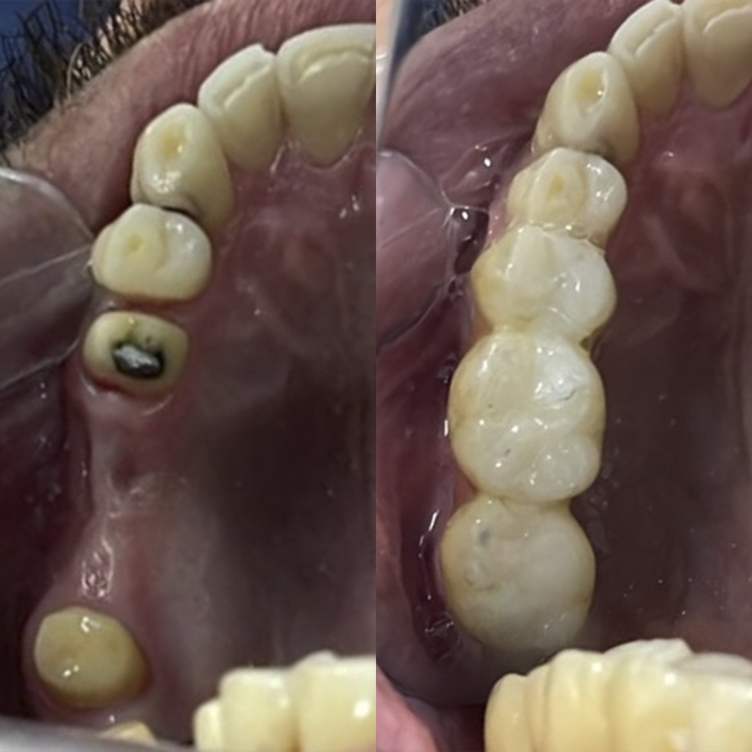 Antes e Depois